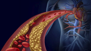 Що е то атеросклероза и опасна ли е?Доц.Калпачки разбива мита