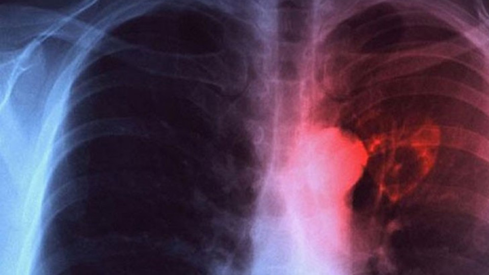 Кои ранни признаци предупреждават за туберкулоза?