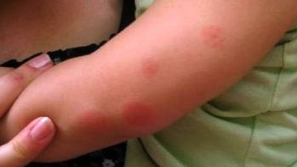 Какви неподозирани опасности крие ухапването от комар