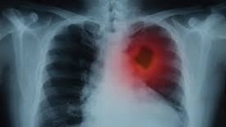 Три сигурни признака на рак на белите дробове