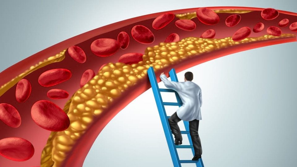 Бъдете внимателни: Тези индикатори алармират за висок холестерол!