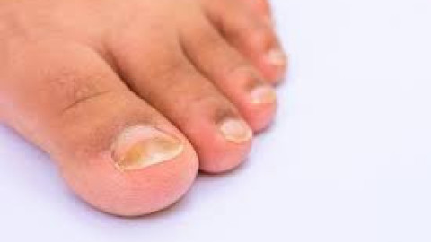 Специалистът съветва: Какво трябва да правим при гъбички по краката?