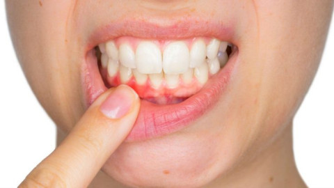 Народната медицина срещу парадонтозата! Изпитани рецепти