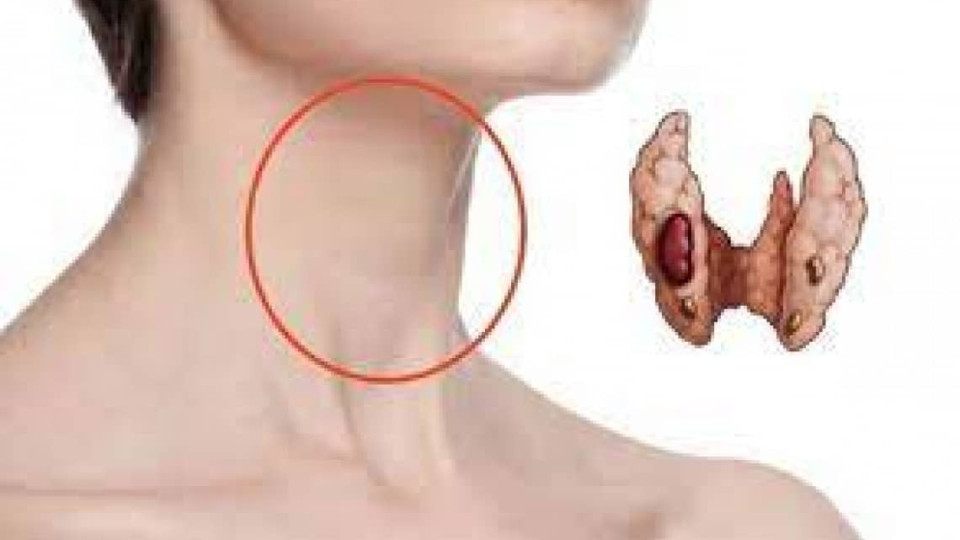Защо здравето на щитовидната жлеза е толкова важно? (От какви болести страда)