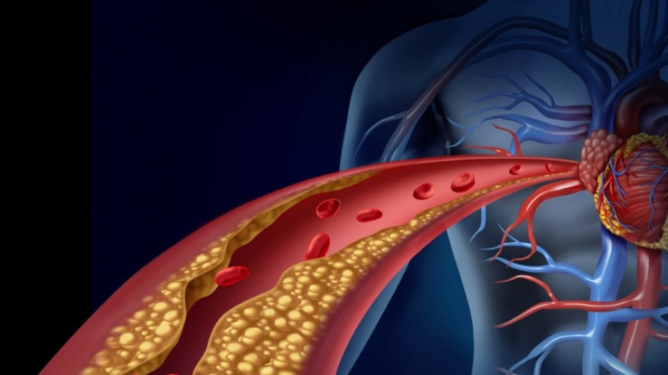 Какво е общото: Между холестерола, атеросклерозата и плаките в кръвоносните съдове?