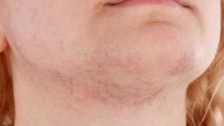 Имате косъмчета по лицето: Премахнете ги с този прост и бърз метод