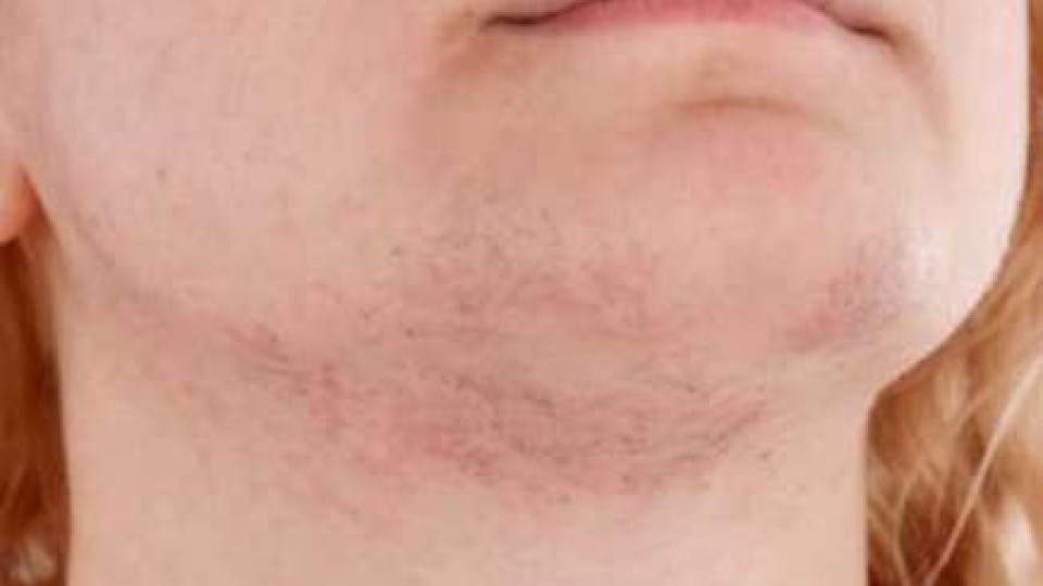 Имате косъмчета по лицето: Премахнете ги с този прост и бърз метод