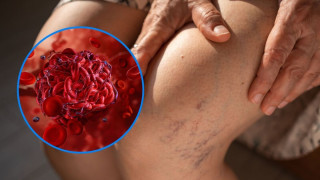 Какви мерки да вземем при прекомерното съсирване на кръвта?