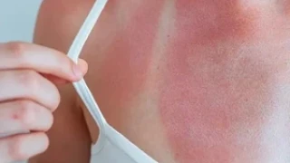 При слънчево изгаряне: Кога може да се лекувате сами и кога е забранено!